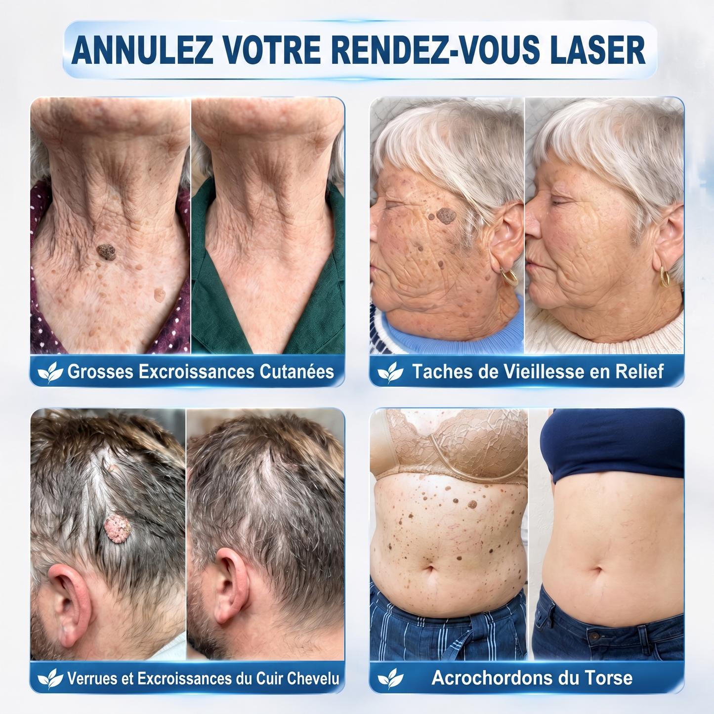 【🔥 Dernier jour : -70 % 🔥】🇫🇷 𝐇𝐞𝒂𝒍𝗿𝗶𝙯𝙚® Patch 2-en-1 à micro-aiguilles & hydrocolloïde | Aide à réduire l’apparence des grains de beauté, verrues, acné et étiquettes cutanées | Patchs invisibles visage & corps.