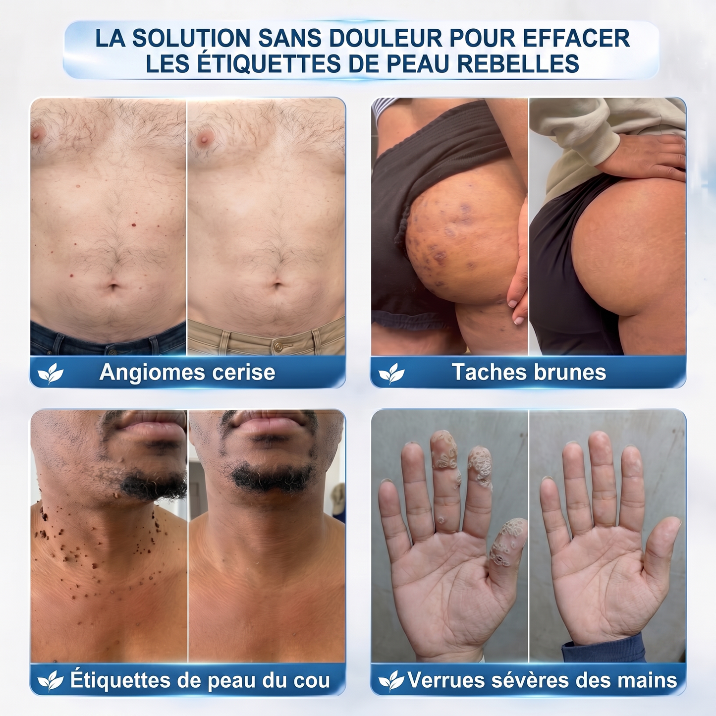 【🔥 Dernier jour : -70 % 🔥】🇫🇷 𝐇𝐞𝒂𝒍𝗿𝗶𝙯𝙚® Patch 2-en-1 à micro-aiguilles & hydrocolloïde | Aide à réduire l’apparence des grains de beauté, verrues, acné et étiquettes cutanées | Patchs invisibles visage & corps.