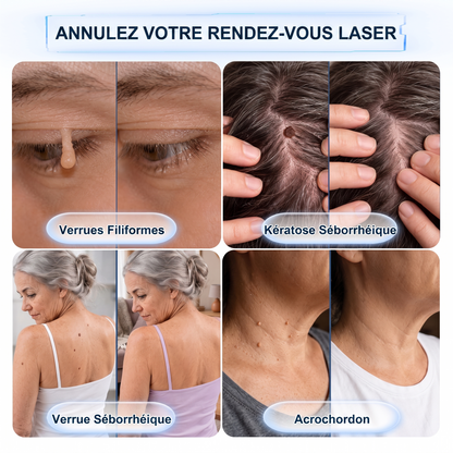 【🔥 Dernier jour : -70 % 🔥】🇫🇷 𝐇𝐞𝒂𝒍𝗿𝗶𝙯𝙚® Patch 2-en-1 à micro-aiguilles & hydrocolloïde | Aide à réduire l’apparence des grains de beauté, verrues, acné et étiquettes cutanées | Patchs invisibles visage & corps.