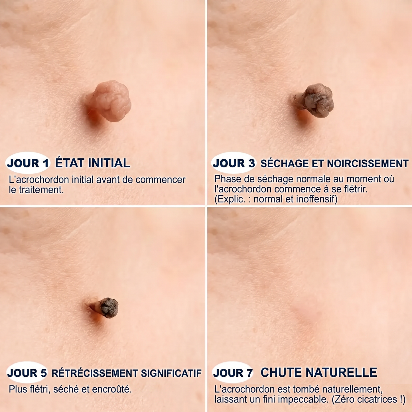 【🔥 Dernier jour : -70 % 🔥】🇫🇷 𝐇𝐞𝒂𝒍𝗿𝗶𝙯𝙚® Patch 2-en-1 à micro-aiguilles & hydrocolloïde | Aide à réduire l’apparence des grains de beauté, verrues, acné et étiquettes cutanées | Patchs invisibles visage & corps.
